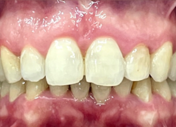 After - Partington Dental