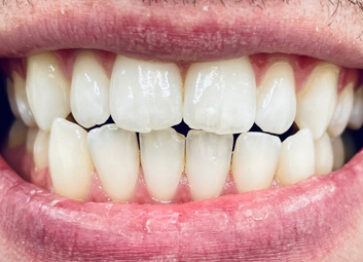 After - Partington Dental