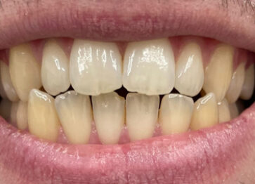 Before - Partington Dental