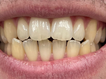 Before - Partington Dental