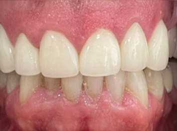 After - Partington Dental