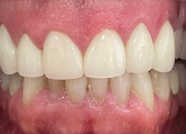 After - Partington Dental